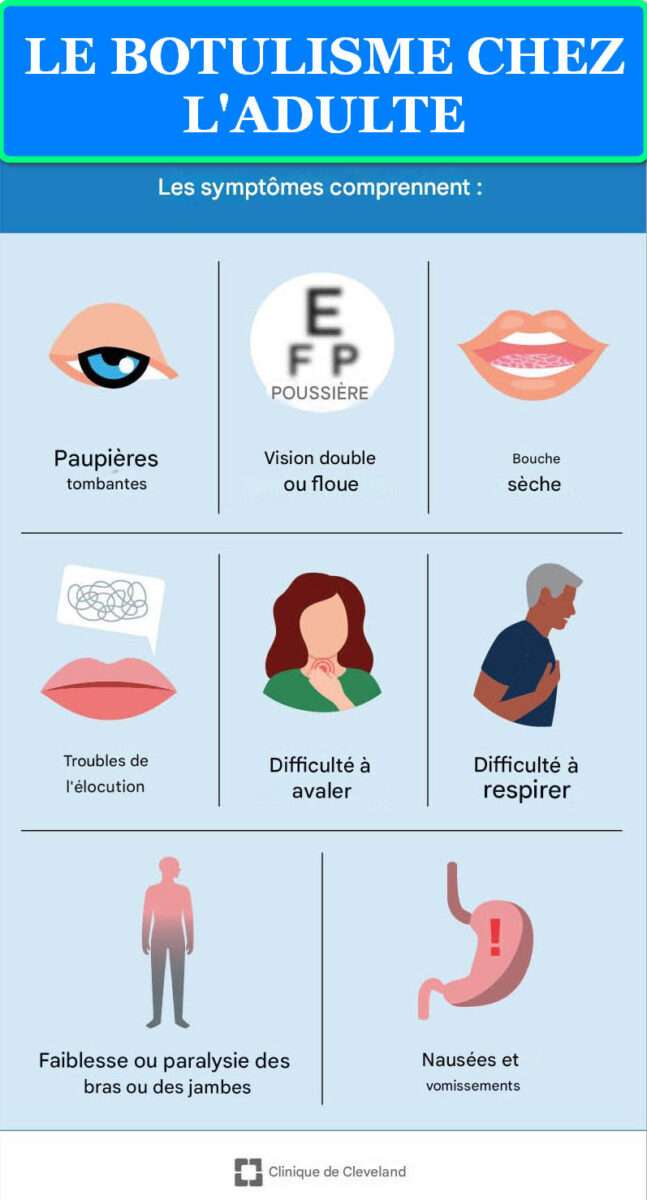 LE BOTULISME CHEZ L'ADULTE LE BOTULISME CHEZ L'ADULTE