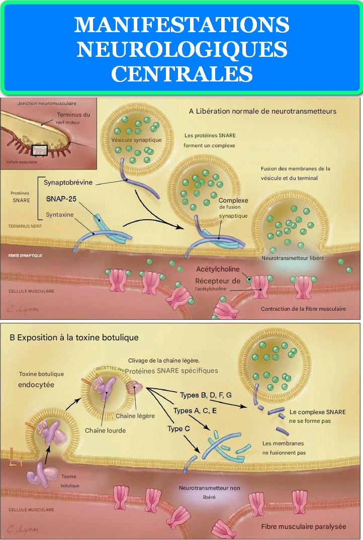 MANIFESTATIONS NEUROLOGIQUES CENTRALES MANIFESTATIONS NEUROLOGIQUES CENTRALES
